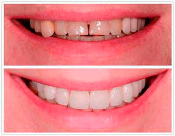 Фото зубов: до использования и со съемными винирами