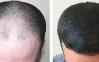 Результат применения средства восстановления волос BeeHair у мужчины