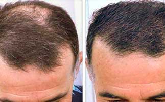 Результат применения средства восстановления волос BeeHair у мужчины