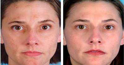 До и после использования Beauty Skin Care