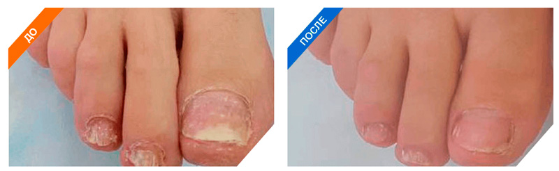 Изображения ногтей и ног до и после применения Микоцина