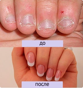 ногти до и после применения Нейлз