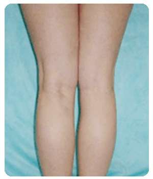 Ноги после применения Варитонуса от варикоза